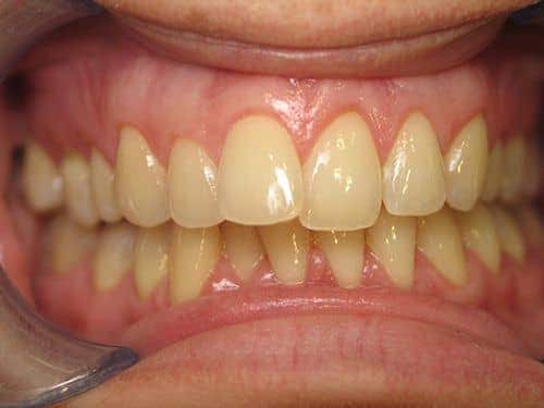 Nổi đau đằng sau nụ cười "toả nắng" từ việc tẩy trắng răng 4 rang vang