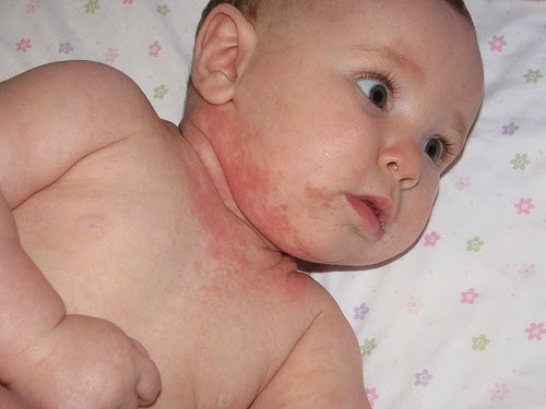Kem bôi Aveeno trị tràm ở trẻ em Aveeno Baby Eczema Therapy Moisturizing Cream 141g
