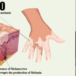 Viên uống thảo dược tái tạo da Vitilax Herbal Capsule for Vitiligo 150 viên 6 vitiligo bach bien
