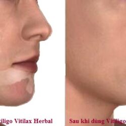 Viên uống thảo dược tái tạo da Vitilax Herbal Capsule for Vitiligo 150 viên 7 vitiligo benh bach bien