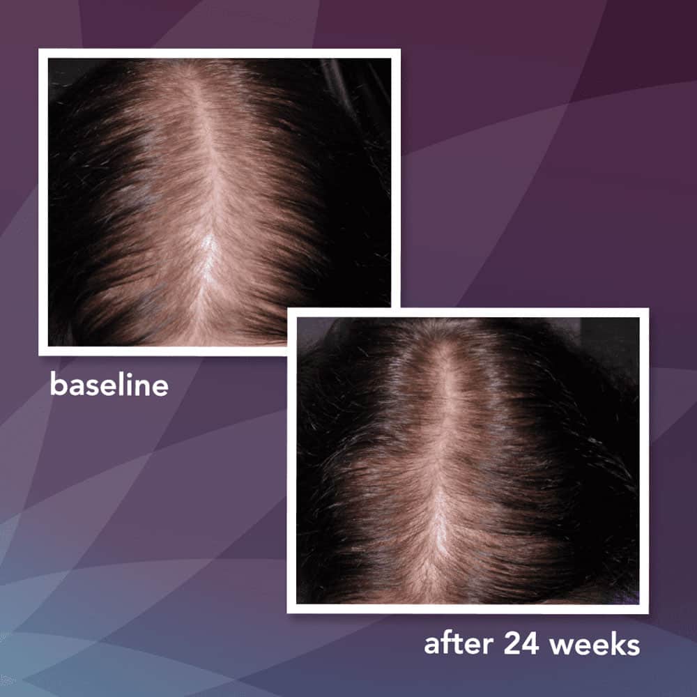 Bọt mọc tóc dành cho phụ nữ Women's Rogaine 5% Minoxidil Set Foam 60g x2 –  Wowmart VN | 100% hàng ngoại nhập