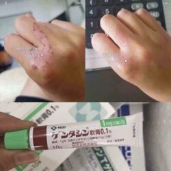 Kem liền sẹo Gentacin hàng nội địa Nhật Bản tuýp 10g 7 Kem trị sẹo Gentacin hàng nội địa Nhật Bản Tuýp 10g