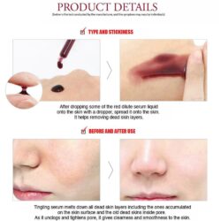 Tinh chất Peal thay da không bong tróc Red Peel Tingle Serum 35ml 18 tinh chat peal thay da khong bong troc red peel tingle serum 30ml hq