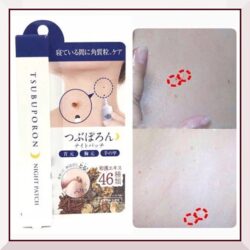 kem loai bo vung co khoi u nho liberta tsubuporon night patch 20g6