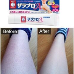 Kem giảm viêm nang lông Rohto Medical Zala Pro A Skin Cream 35g 8 Kem tri viem nang long Rohto Medical Zala Pro A Skin Cream 35g4