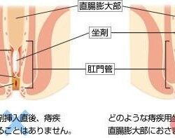 Viên đặt trĩ chữ A Borraginol 30 viên 8 Vien dat tri chu A Borraginol 30 vien3