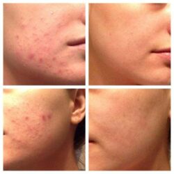 Set giảm mụn Murad Blemish Control Power Couple 5 set tri mun murad blemish control power couple kx