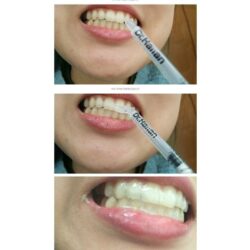 But trang rang Dr Haiian Tooth Whitening Gel 1gx 74