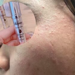 huyet thanh dac tri mun mulgwang diamond m13 10ml kf