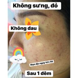 huyet thanh dac tri mun mulgwang diamond m13 10ml kg