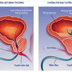 vien uong ho tro dieu tri tuyen tien liet blackmores prostate health formula 60 vien kc