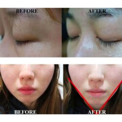Thanh lăn mặt 28 Days Medi Peel Perfect Cooling Skin 15 thanh lan mat 28 days medi peel perfect cooling skin kf