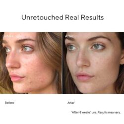 Kem giảm sẹo mụn Murad Invisiscar Resurfacing Treatment 15ml 12 kem dac tri seo mun murad invisiscar resurfacing treatment 15ml kc