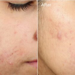 Kem giảm sẹo mụn Murad Invisiscar Resurfacing Treatment 15ml 14 kem dac tri seo mun murad invisiscar resurfacing treatment 15ml ke