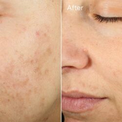 Kem giảm sẹo mụn Murad Invisiscar Resurfacing Treatment 15ml 16 kem dac tri seo mun murad invisiscar resurfacing treatment 15ml kg