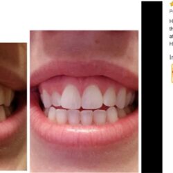 Miếng dán trắng răng Crest 3D Whitestrips Arctic Mint 28 miếng (14 cặp)+ 1 tuýp serum 21 mieng dan trang rang crest 3d whitestrips arctic mint 28 mieng 14 cap 1 tuyp serum ki