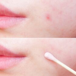 lotion ngua mun giam tham mario badescu buffering lotion 29ml kg