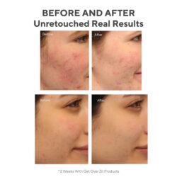 set tieu diet mun murad get over zit ka