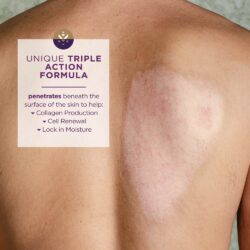 Kem liền sẹo Mederma Advanced Scar Gel 20g 14 kem lien seo mederma advanced scar gel 50g kc