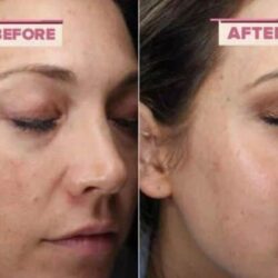 Kem ngừa mụn và trẻ hóa da The Perfect A 30ml 9 kem ngua mun va tre hoa da the perfect a 30ml kd