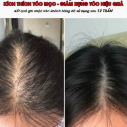Serum mọc tóc Weilaiya With Ginger Polygonum 5ml x 8 lọ 22 serum moc toc weilaiya with ginger polygonum 5ml x 8 lo kb