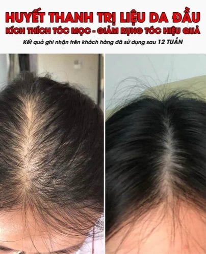 Serum mọc tóc Weilaiya With Ginger Polygonum 5ml x 8 lọ 37 serum moc toc weilaiya with ginger polygonum 5ml x 8 lo kb