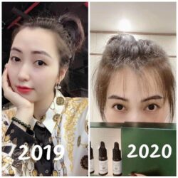 Serum mọc tóc Weilaiya With Ginger Polygonum 5ml x 8 lọ 24 serum moc toc weilaiya with ginger polygonum 5ml x 8 lo ki