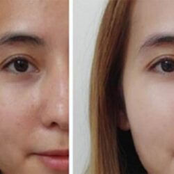 Tinh chất chống lão hóa siêu cấp ẩm MartiDerm Platinum Photo Age HA+ 2ml x30 ống 14 tinh chat chong lao hoa sieu cap am martiderm platinum photo age ha 2ml x30 ong kc