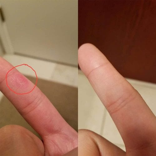 mieng dan loai bo mun coc compound w wart remover one step invisible strips 14 mieng kh