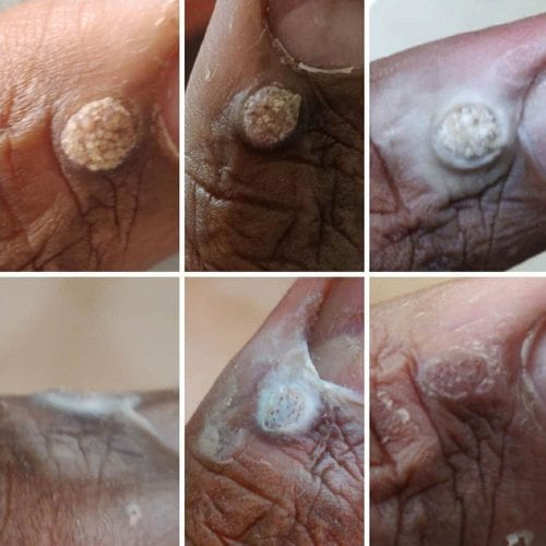 mieng dan loai bo mun coc compound w wart remover one step invisible strips 14 mieng ki