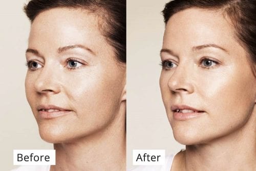 Tinh chất chống lão hóa, làm sáng da Martiderm Black Diamond Skin Complex Advanced 2ml x 30 ống 14 women skin beauty chong lao hoa