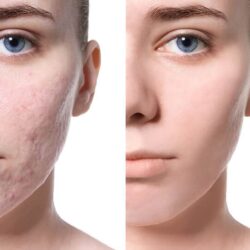 kem boi lam mo seo polysporin heal fast formula original cream 15g kb