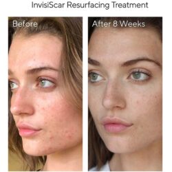 Set kiểm soát mụn Murad Acne Control 30 Days Trial Kit 8 set kiem soat mun murad acne control 30 days trial kit kc