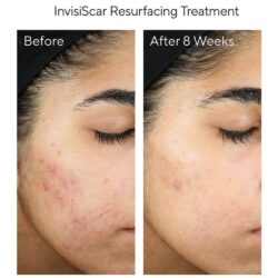 Set kiểm soát mụn Murad Acne Control 30 Days Trial Kit 9 set kiem soat mun murad acne control 30 days trial kit kd