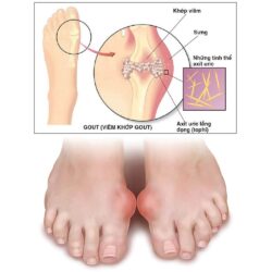 vien uong ho tro benh gut vitatree gout relief 60 tablets kf