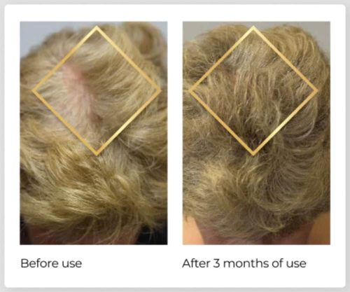 Viên uống hỗ trợ mọc tóc Nature’s Bounty Hair Growth 90 Capsules 10 vien uong ho tro moc toc natures bounty hair growth 90 capsules 231124 kb