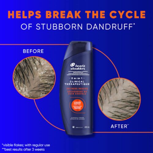 Dầu gội xả sạch gàu Head & Shoulders Clinical Strength 2in1 Dry Scalp Rescue 400ml (Cho da đầu khô) 11 dau goi xa sach gau head shoulders clinical strength 2in1 dry scalp rescue 400ml cho da dau kho 080925 kb